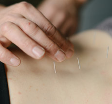 acupuncture ivybridge - Ivybridge Physio and Rehab Treatment